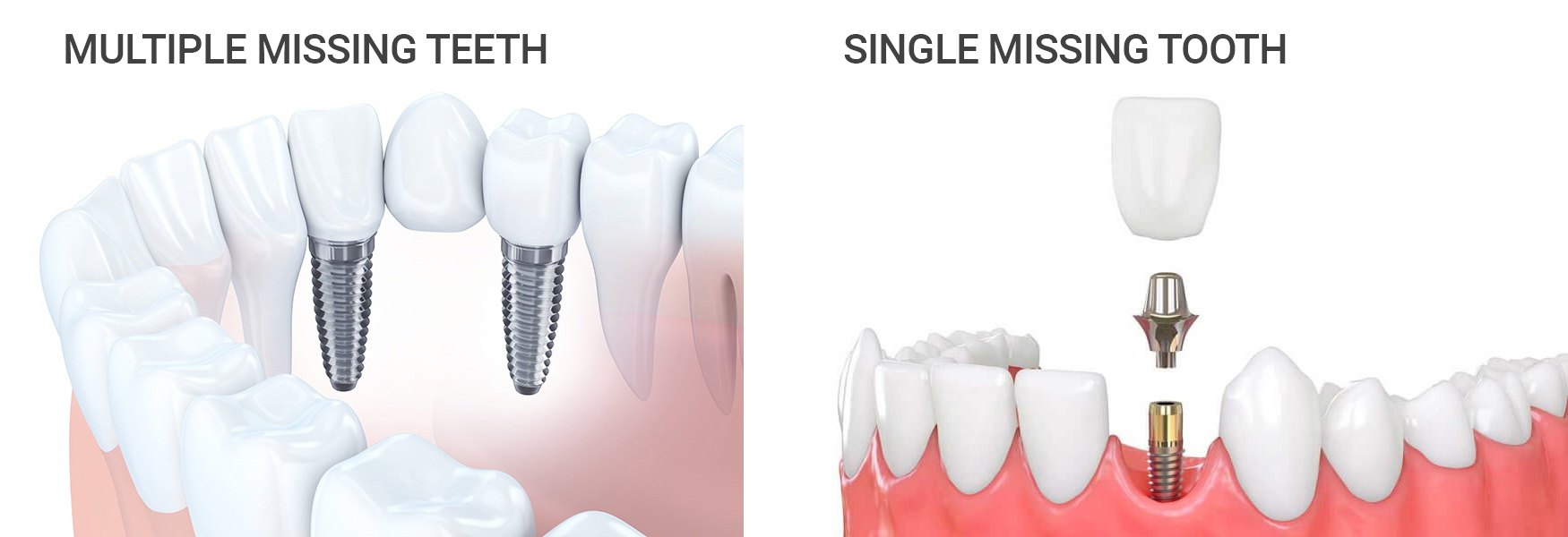 Tooth Implants Knaresborough