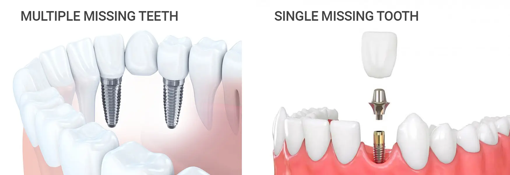 Implant Dentistry Driffield