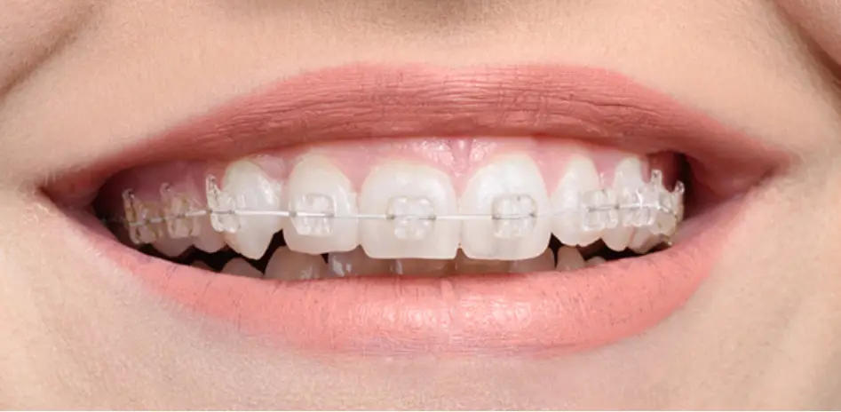 Fixed Braces
