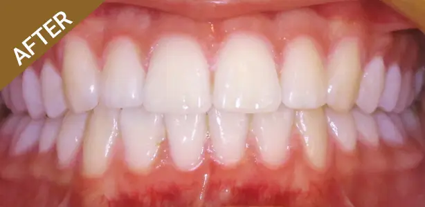 Quick Street Teeth - After
