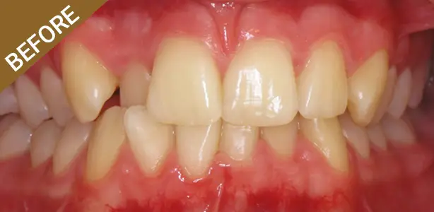 Quick Straight Teeth - Before
