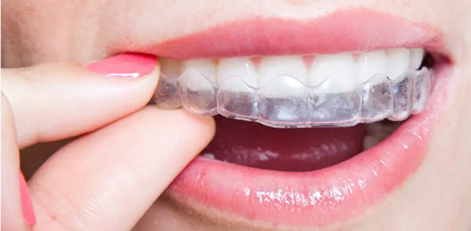 Removable Braces